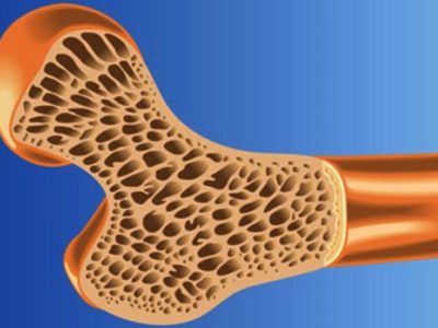 پوکی استخوان؛ بیماری خاموشی که تا شکستگی ادامه دارد